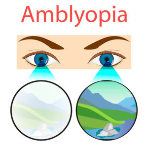 amblyopia_image.jpeg