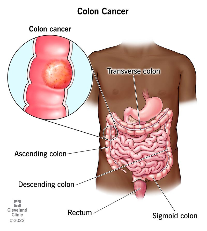 14501colorectalcancer.jpg