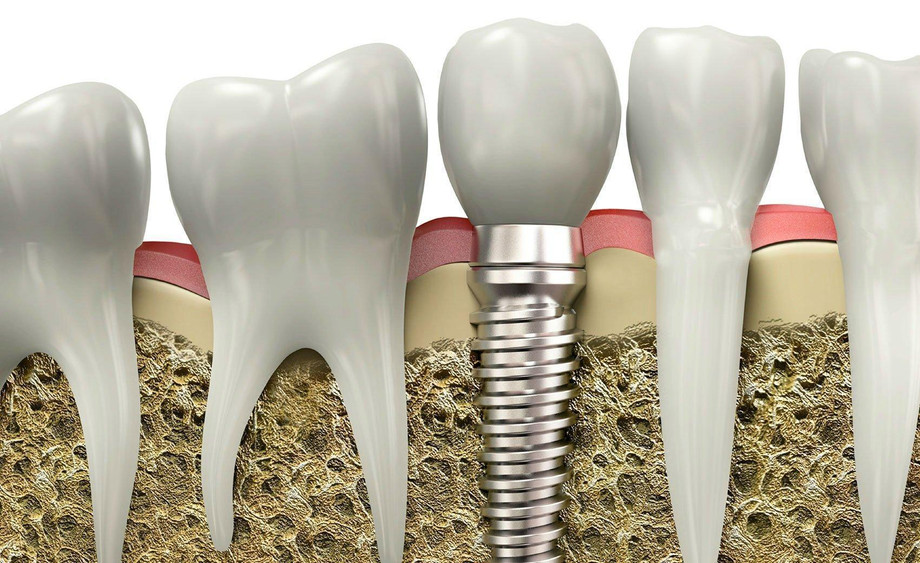 dental_implants_web.jpg
