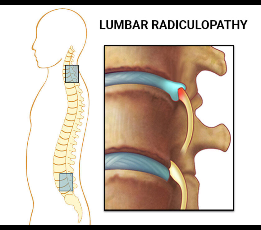 radiculopathy1.jpg