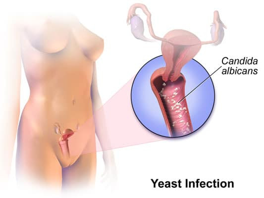 yeast_infection1.jpg