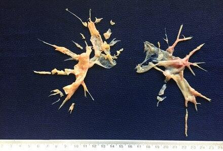 chronicthromboembolicpulmonaryhypertensionmarket.jpg