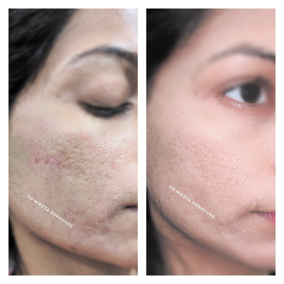 prpskintreatmentinmumbai.jpg