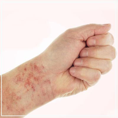 lichenplanus.jpg