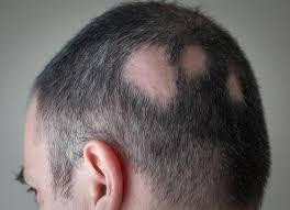 alopeciaareatatreatment.jpg