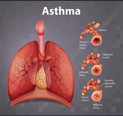 asthma.jpg