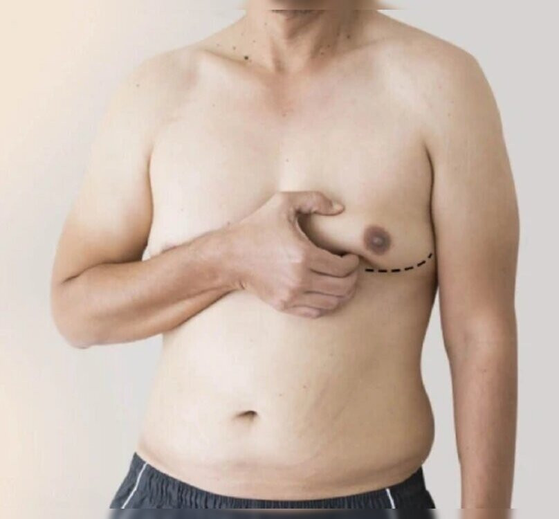 gynecomastia.jpg
