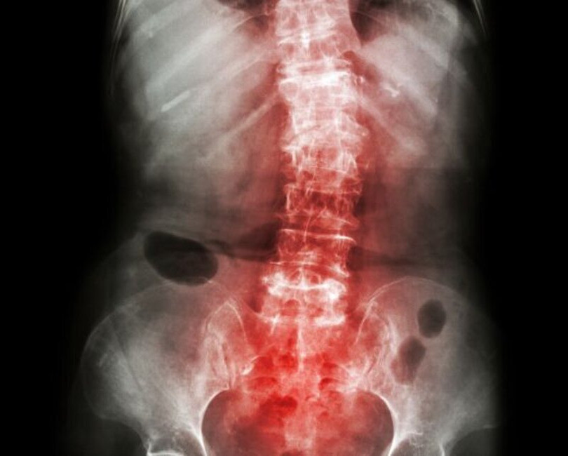 spondylosis1.jpg