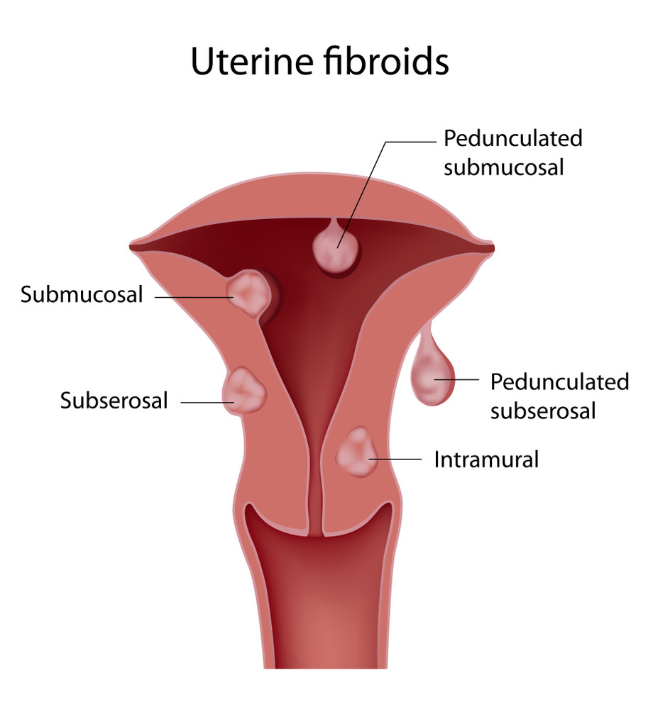 uterine_fibroids.jpg