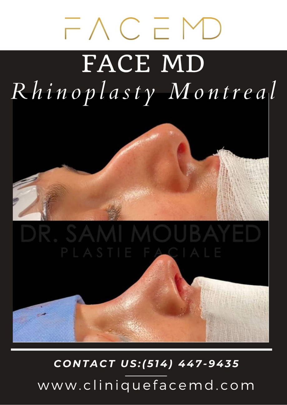 rhinoplastymontreal.jpg