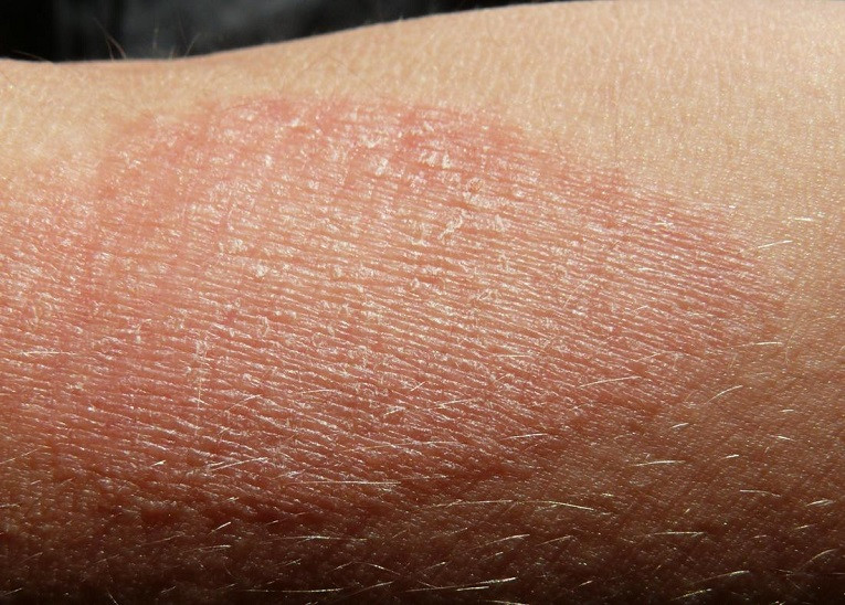 howtocureitchingflakydryskineczend.jpg
