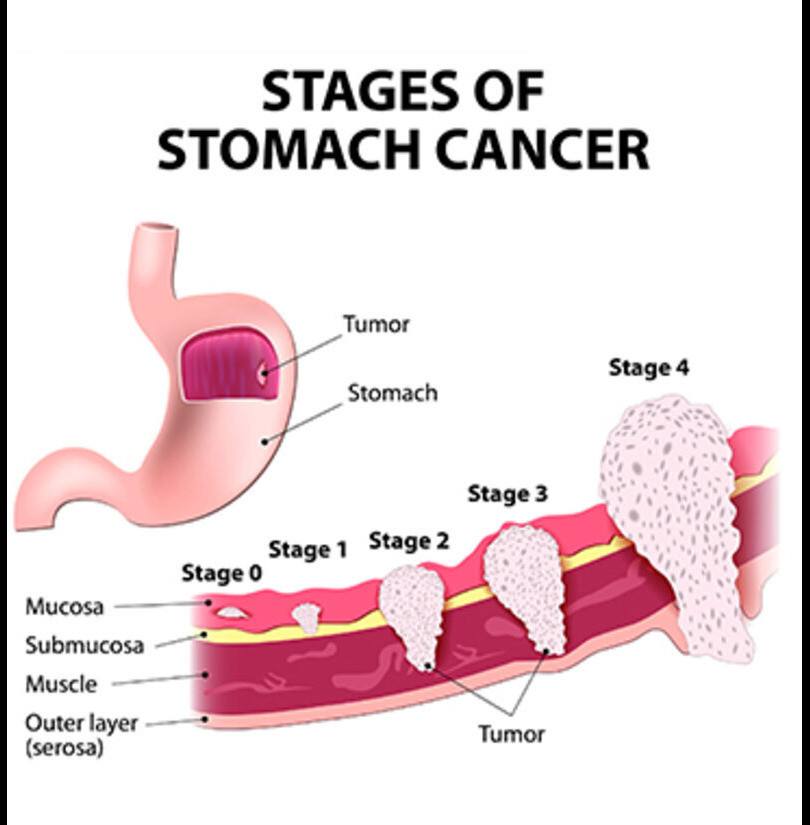 stagesofstomachcancer1.jpg