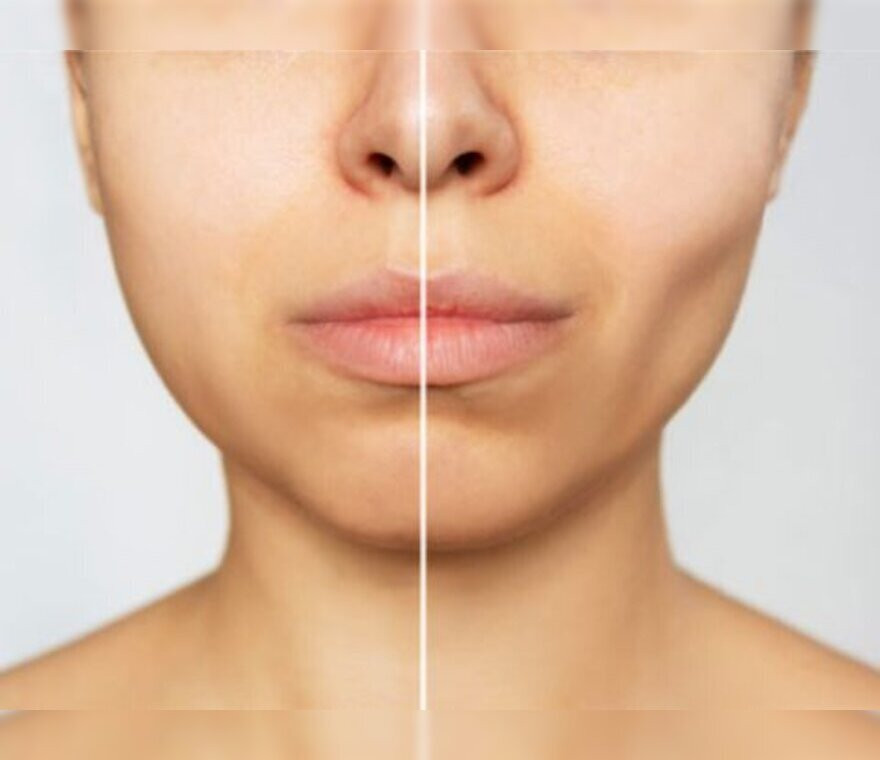 buccalfatremovalinmumbaidramitishahplasticsurgeon480x3601.jpg
