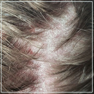seborrheicdermatitistreatment.jpg