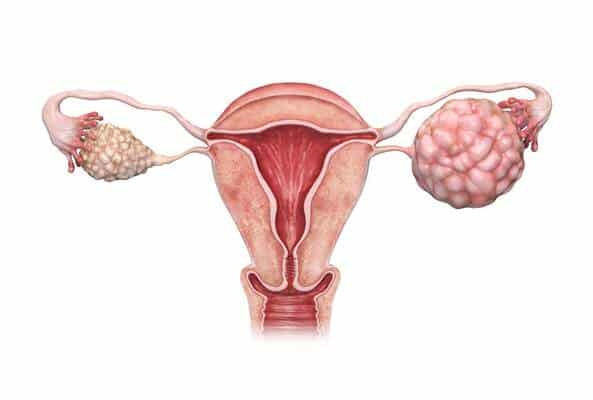 ovariantumor.jpg