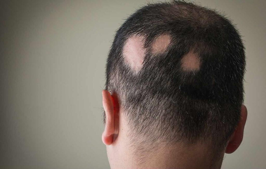 alopeciaareatatreatmentm.jpg