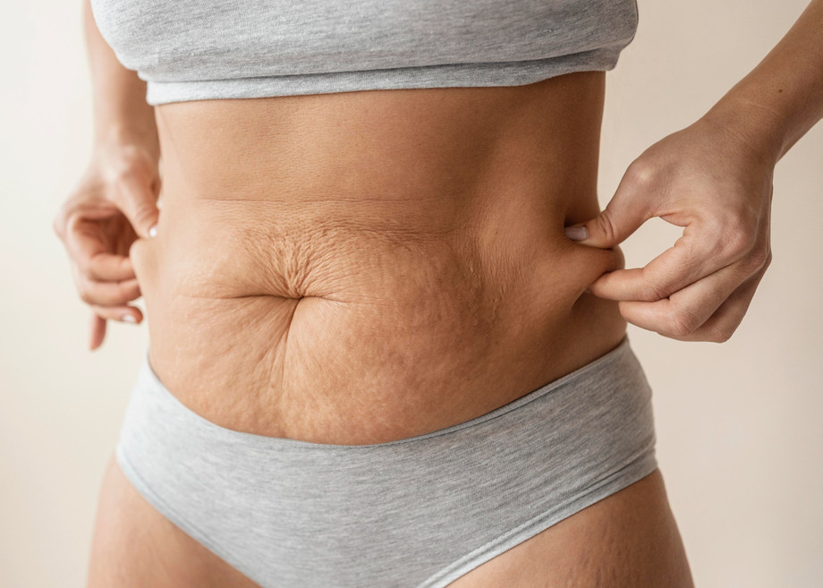 lipedemaafterpregnancyinhyderabad.jpg