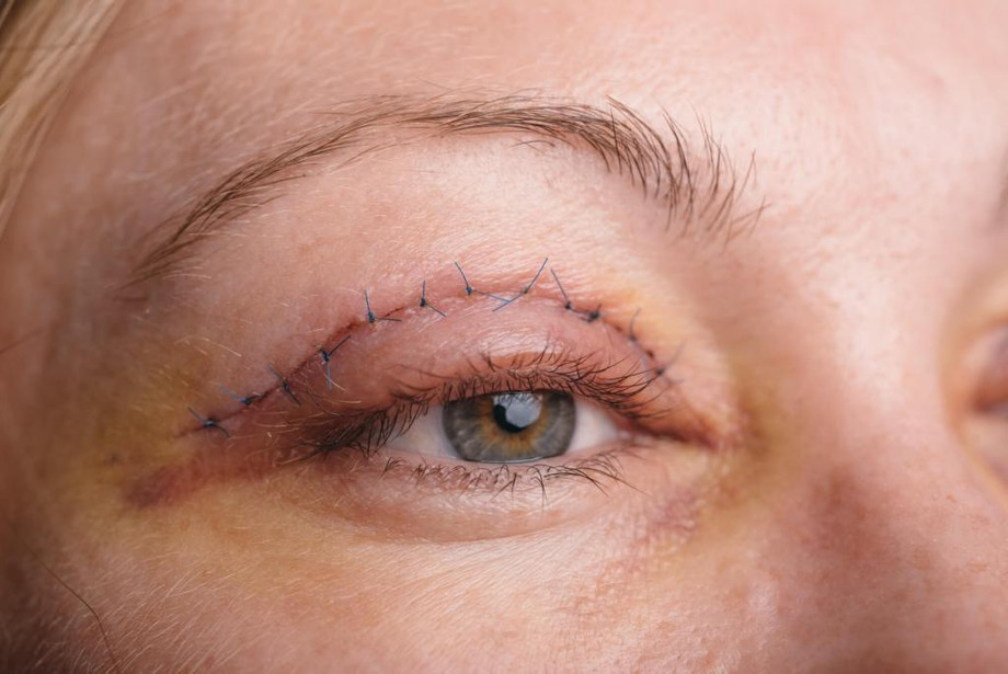 blepharoplastyinmumbaieyelidsurgeryinmumbai1024x684.jpeg