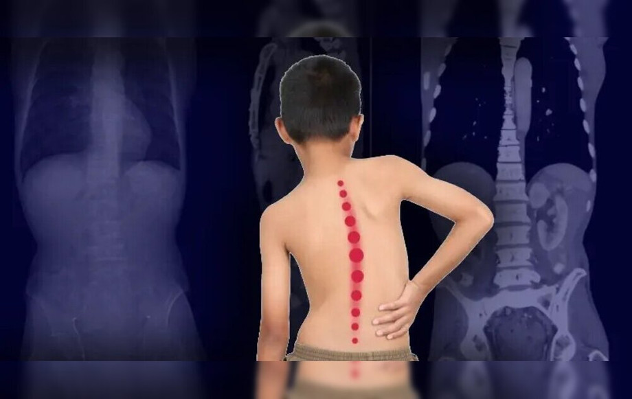scoliosisinyourteensynapse.jpg