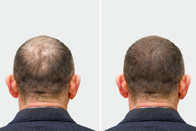 contactadermatologistforapermanenthairfalltreatment.jpg