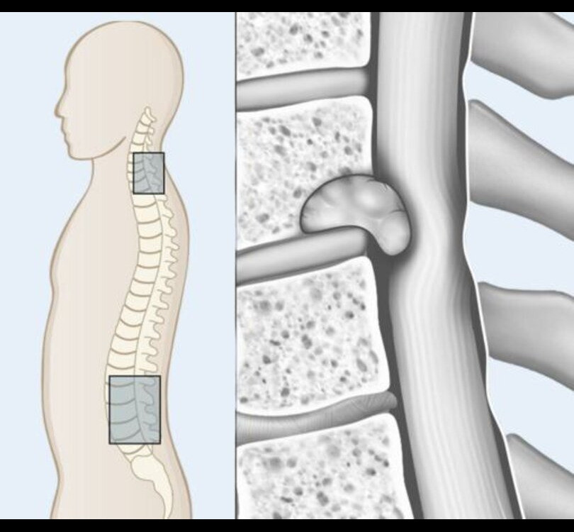 spinaltumors1.jpg