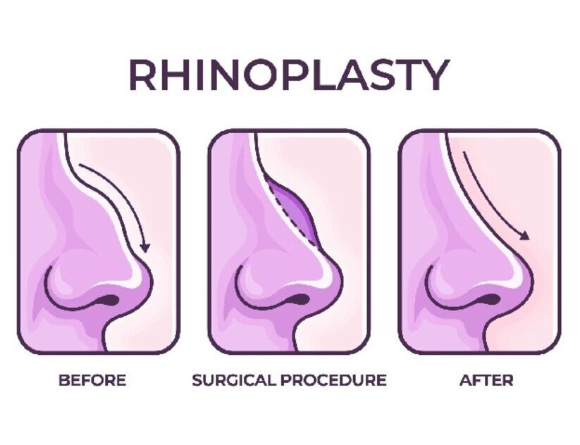 rhinoplastysurgerysanket.jpg