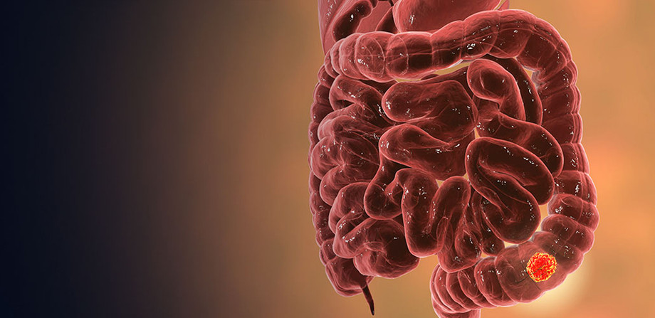 colorectalcancertreatment1.jpg