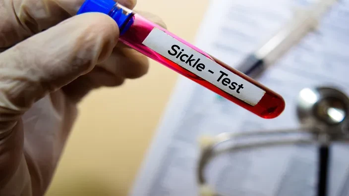 sicklecelltest.webp