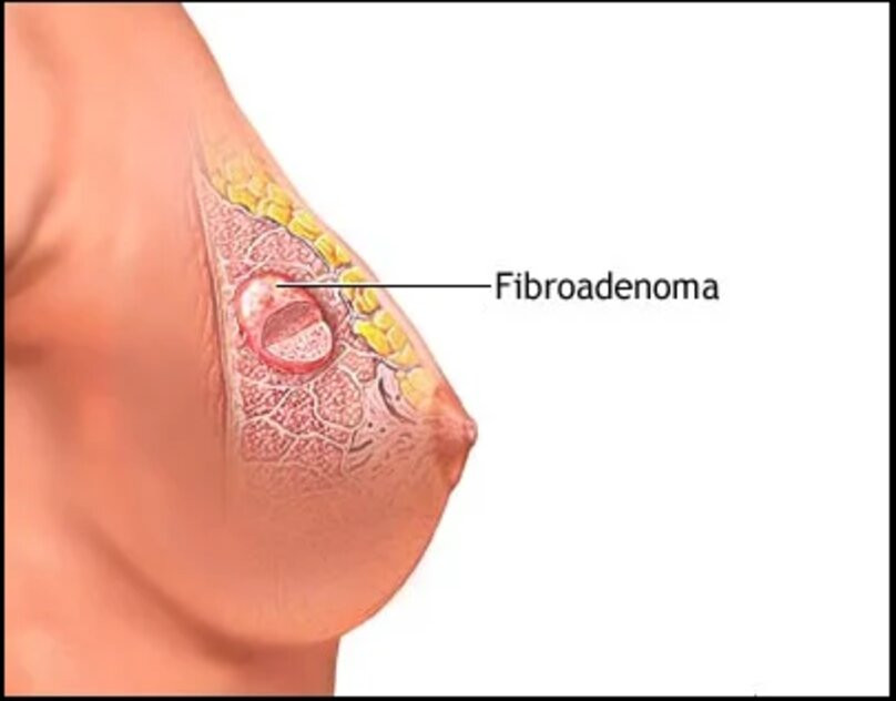 fibroadenomatreatmentsservice500x500.jpg