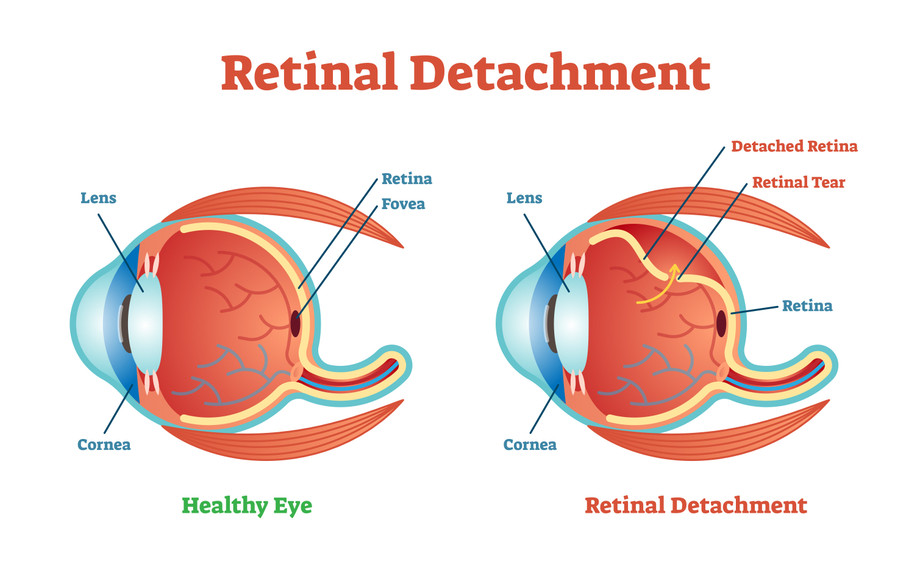 retinaldetachmentnycretina.jpg