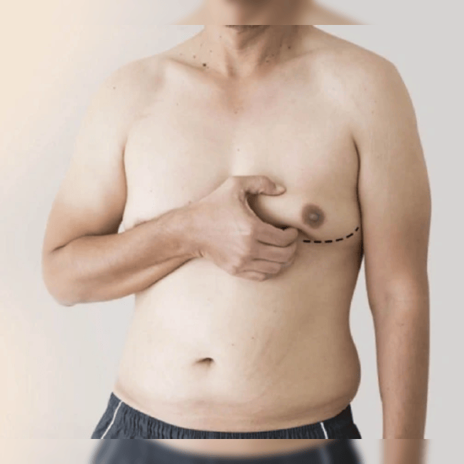 gynecomastia.png