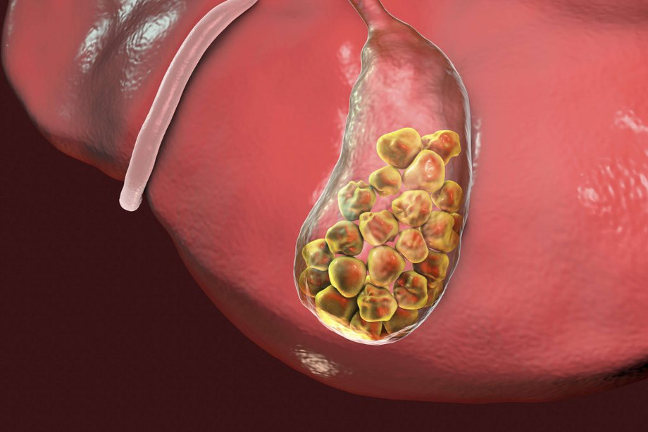 gallstones1024x683.jpg