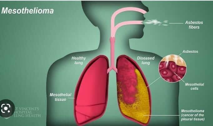 mesothelioma.jpeg