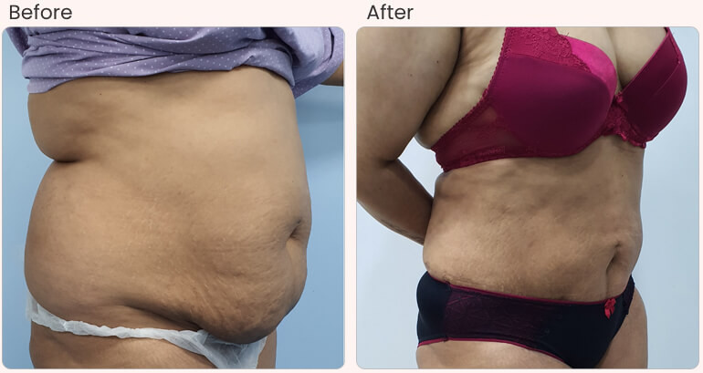 beforeafterresultliposuction02.jpg