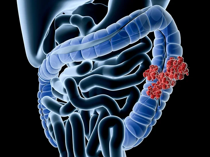 colorectal_colon_cancer732x549thumbnail2.webp