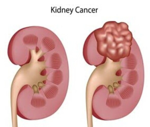 kidneycancer1.jpg