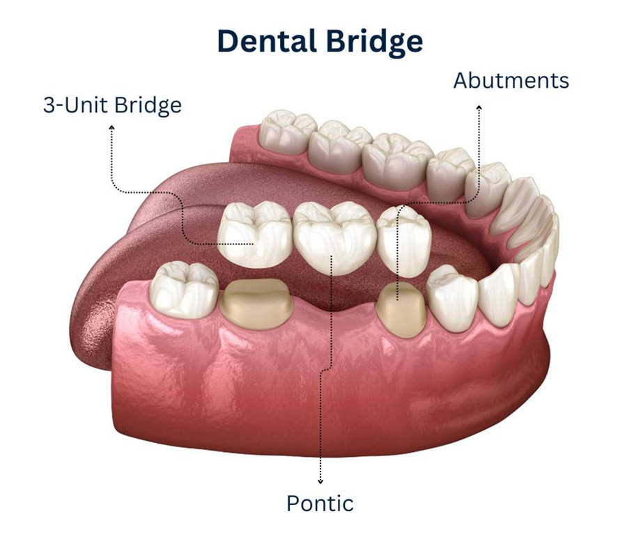 dentalbridge.jpg