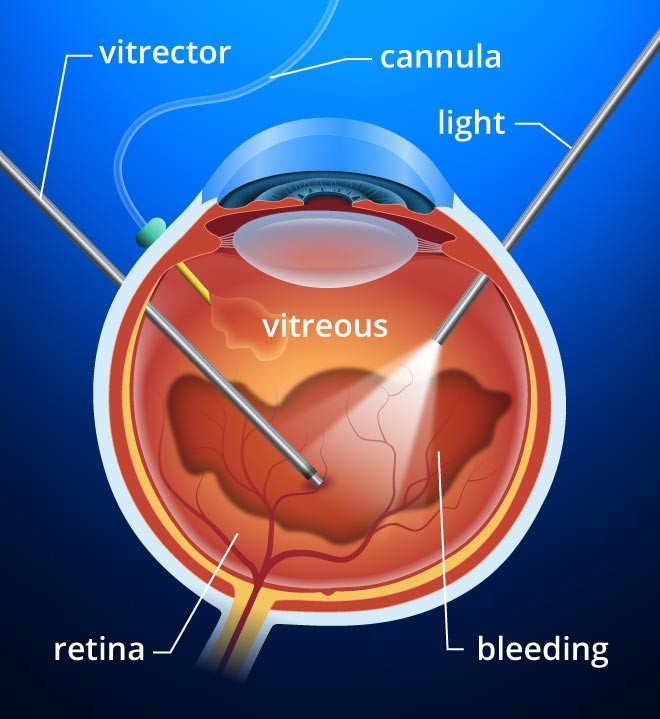 vitrectomy330x3602x.jpg