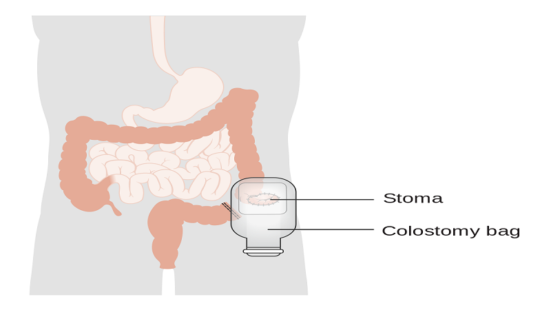 colostomy.png