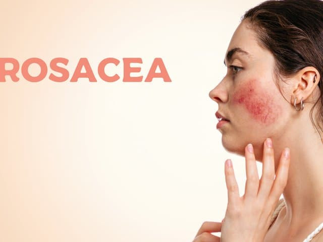 womanwithinflamedbloodvesselsonhercheeksandencryptedrosaceaword.jpg
