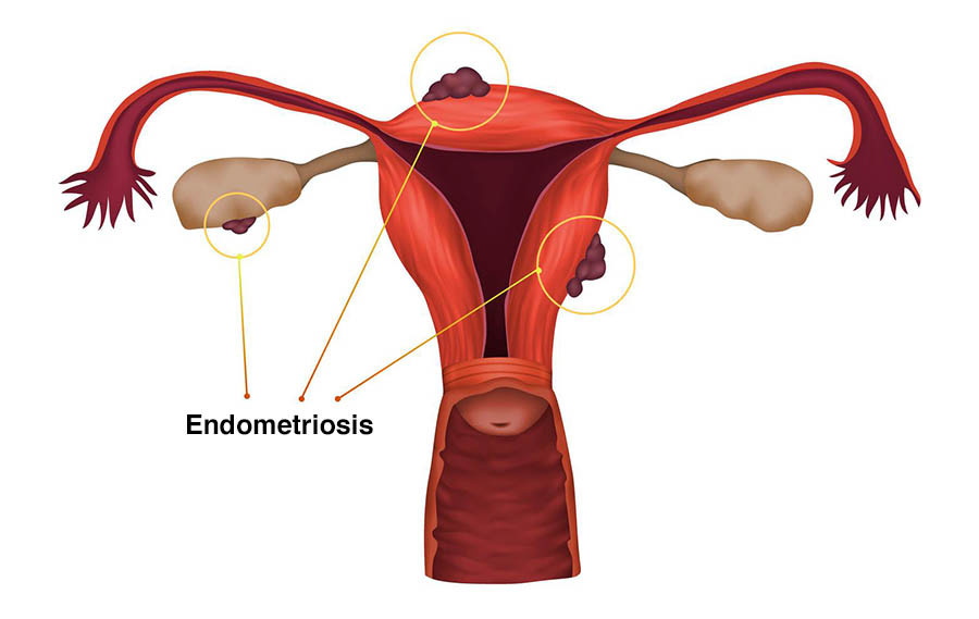 endometriosisillustrationfcc644.jpg
