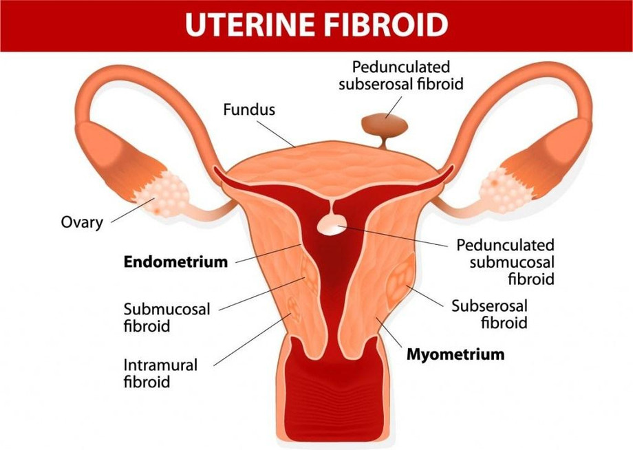 uterinefibroids.jpg