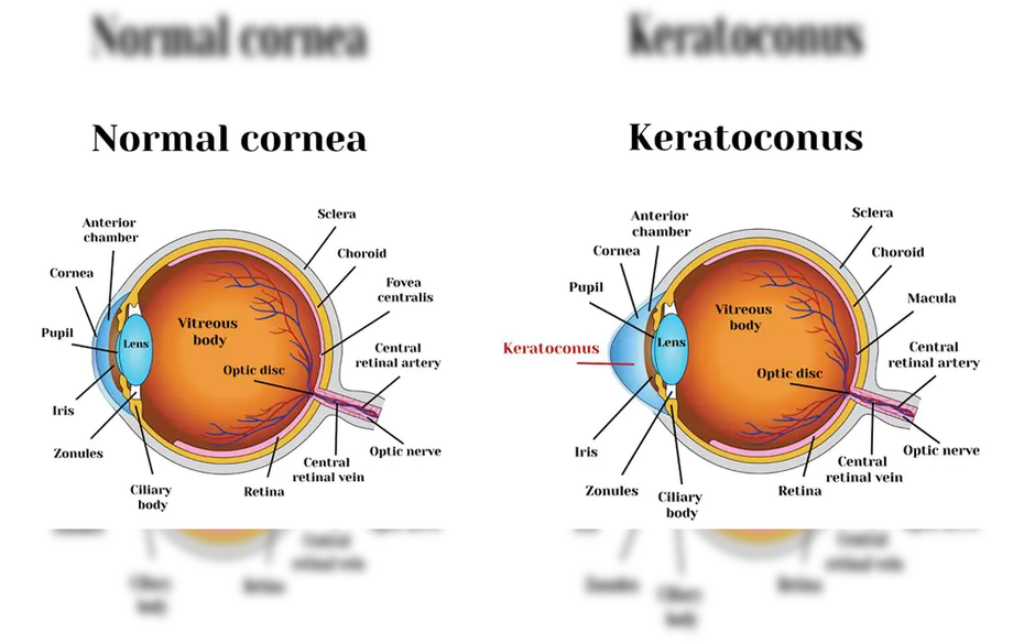 corneaandcornealdiseases.png