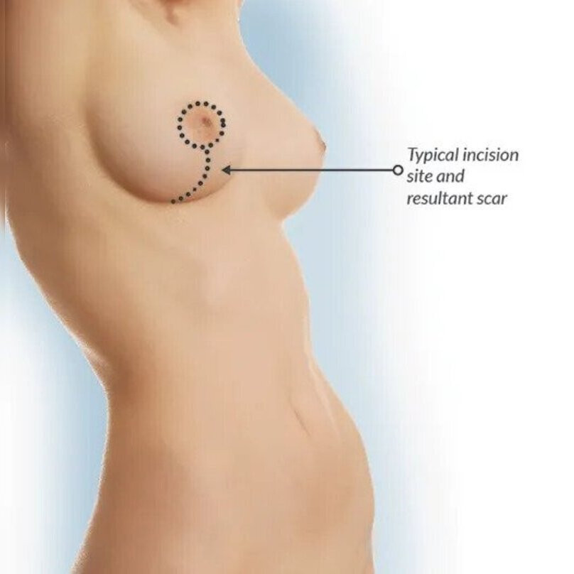 breastliftamiti.jpg