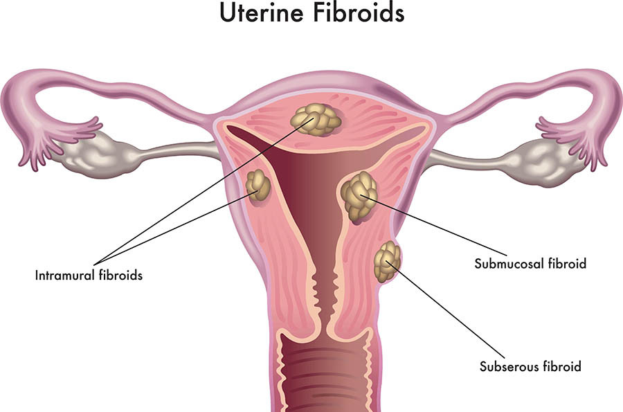 fibroids.jpg