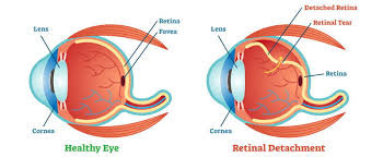 retinasurgery.jfif