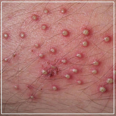 folliculitis.jpg