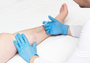 copyofsclerotherapyshutterstock_1283406964300x210.jpg