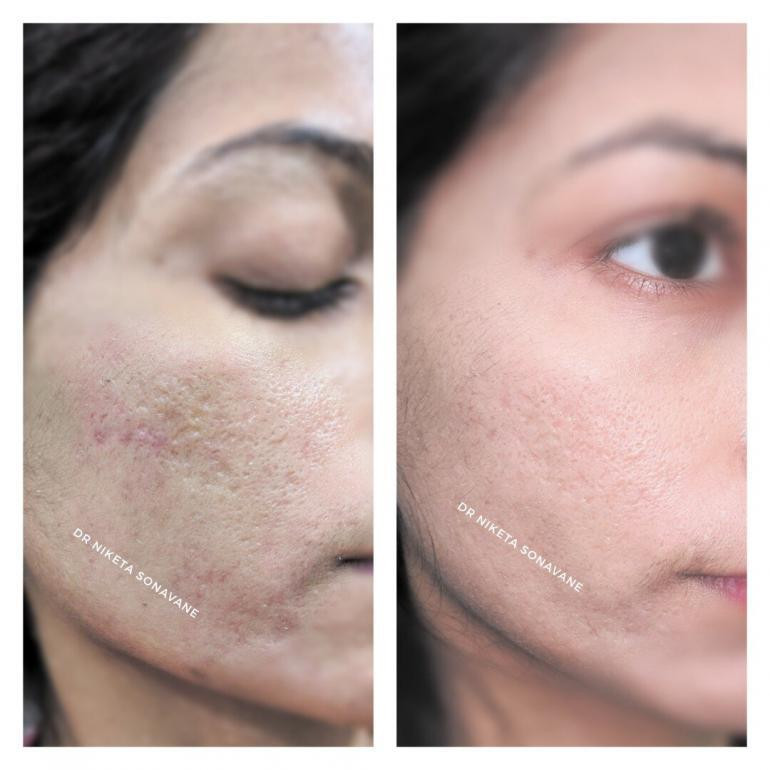 acnescarstreatmentinmumbaimicroneedlinginmumbaibeforeafter770x770.jpg