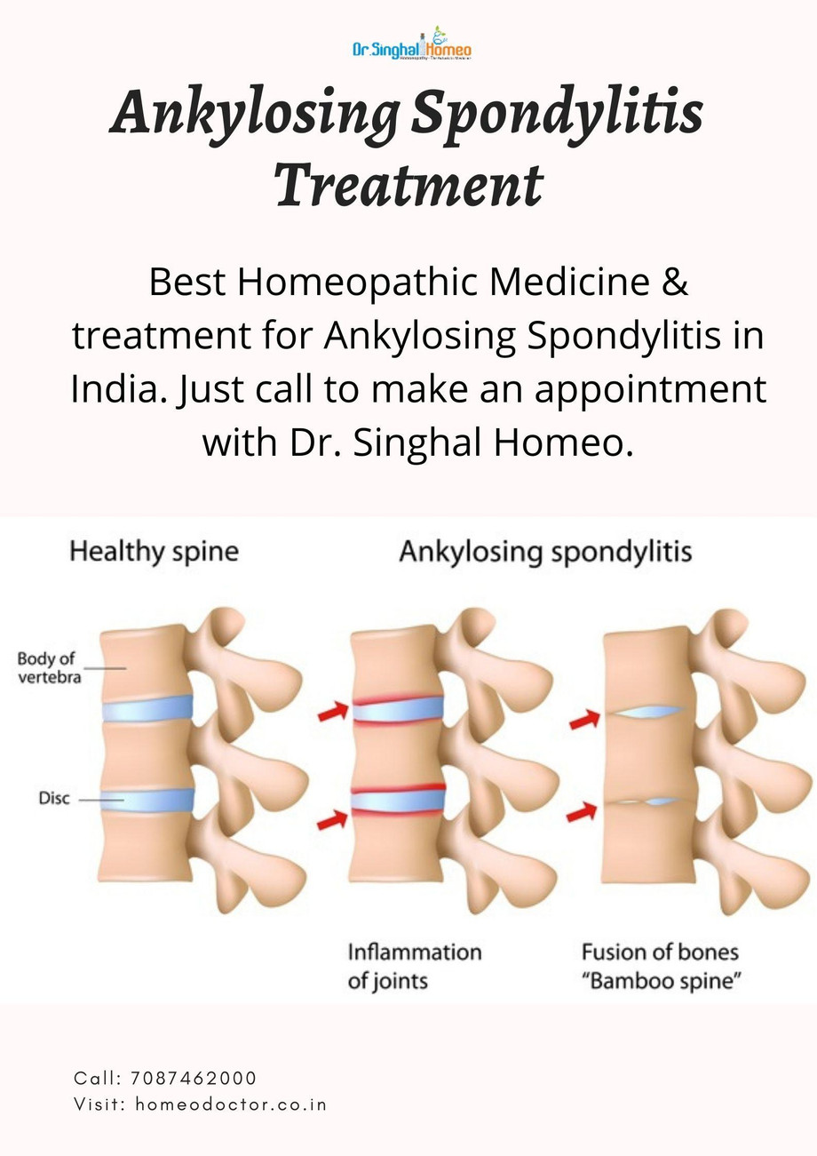 ankylosingspondylitistreatment.jpg